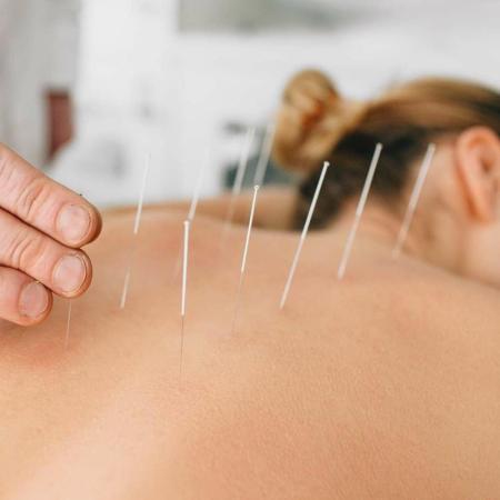 Acupuntura